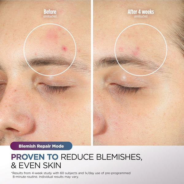 Shark CryoGlow LED Face Mask with Under-Eye Cooling, Anti-Ageing & Blemish Repair, Red & Blue LED, Infrared Light Therapy, USB-C, Remote Control, Storage Bag, Adjustable Straps